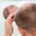 causes of hair loss