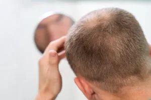 Why Am I Losing Hair? The Most Common Causes of Hair Loss in Men & Women (And How to Treat Them)